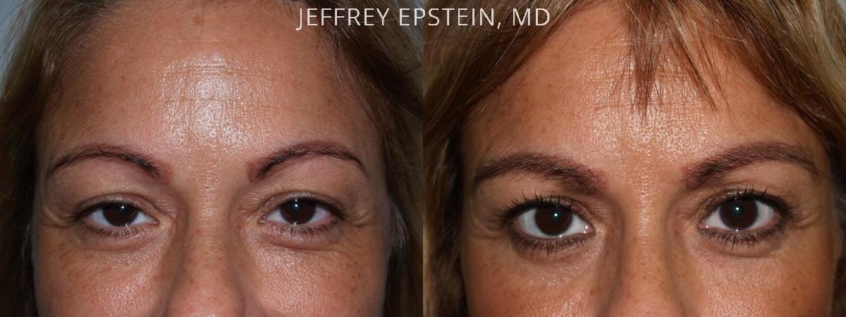 Eyebrow Hair Transplant Before and after in Miami, FL, Paciente 35984