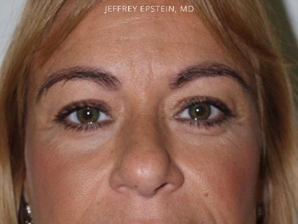 Eyebrow Hair Transplant Before and after in Miami, FL, Paciente 35984