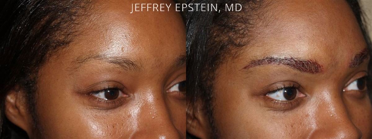 Eyebrow Hair Transplant Before and after in Miami, FL, Paciente 35995