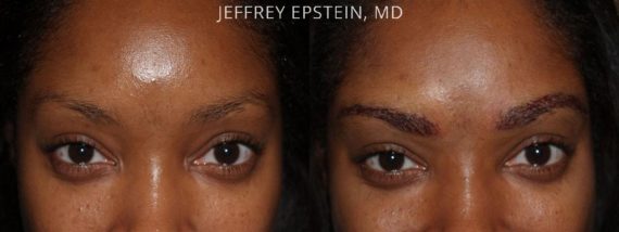 Eyebrow Hair Transplant Before and after in Miami, FL, Paciente 35995