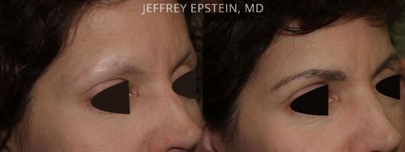 Eyebrow Hair Transplant Before and after in Miami, FL, Paciente 36002