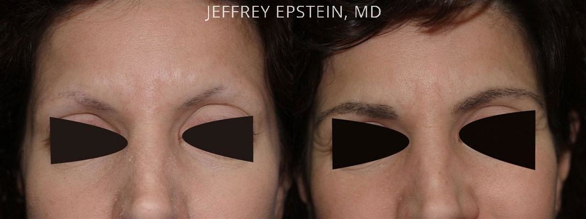 Eyebrow Before and after in Miami, FL, Paciente 36002