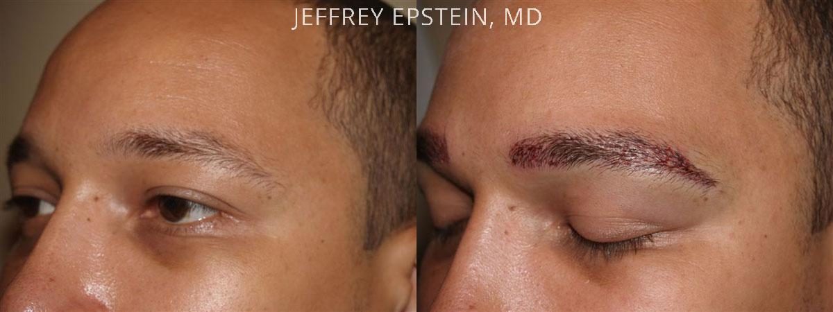 Eyebrow Hair Transplant Before and after in Miami, FL, Paciente 36018