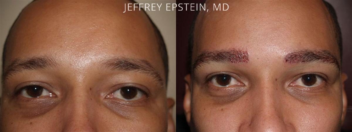 Eyebrow Before and after in Miami, FL, Paciente 36018