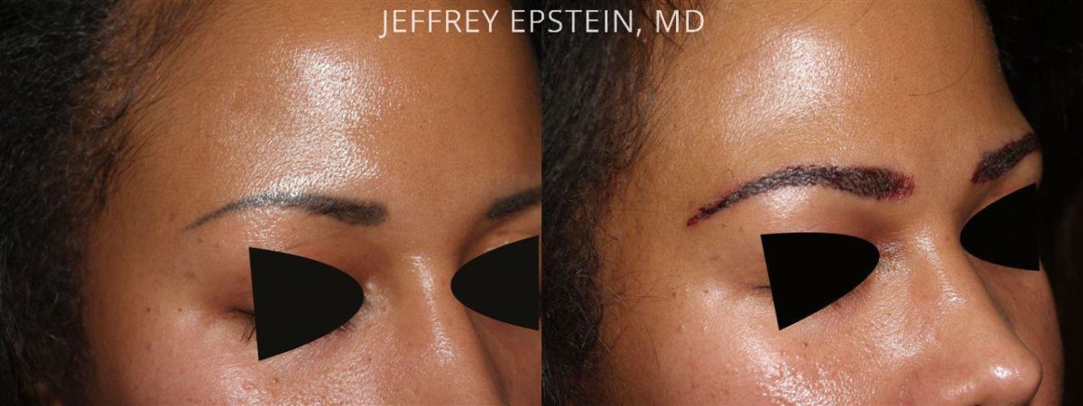 Eyebrow Hair Transplant Before and after in Miami, FL, Paciente 36023