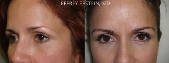 Eyebrow Hair Transplant Before and after in Miami, FL, Paciente 36028