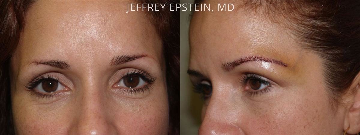 Eyebrow Hair Transplant Before and after in Miami, FL, Paciente 36028