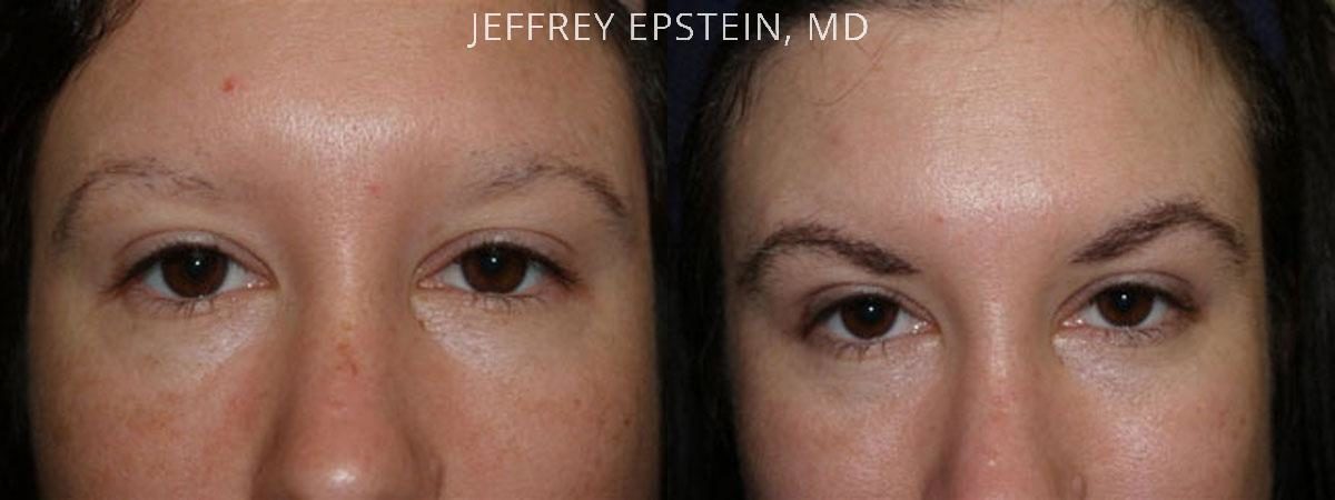 Eyebrow Before and after in Miami, FL, Paciente 36034