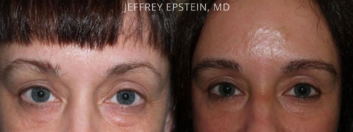 Eyebrow Hair Transplant Before and after in Miami, FL, Paciente 36039