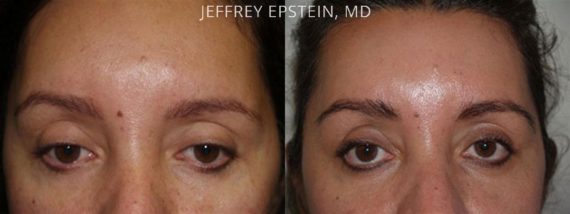 Eyebrow Hair Transplant Before and after in Miami, FL, Paciente 36044