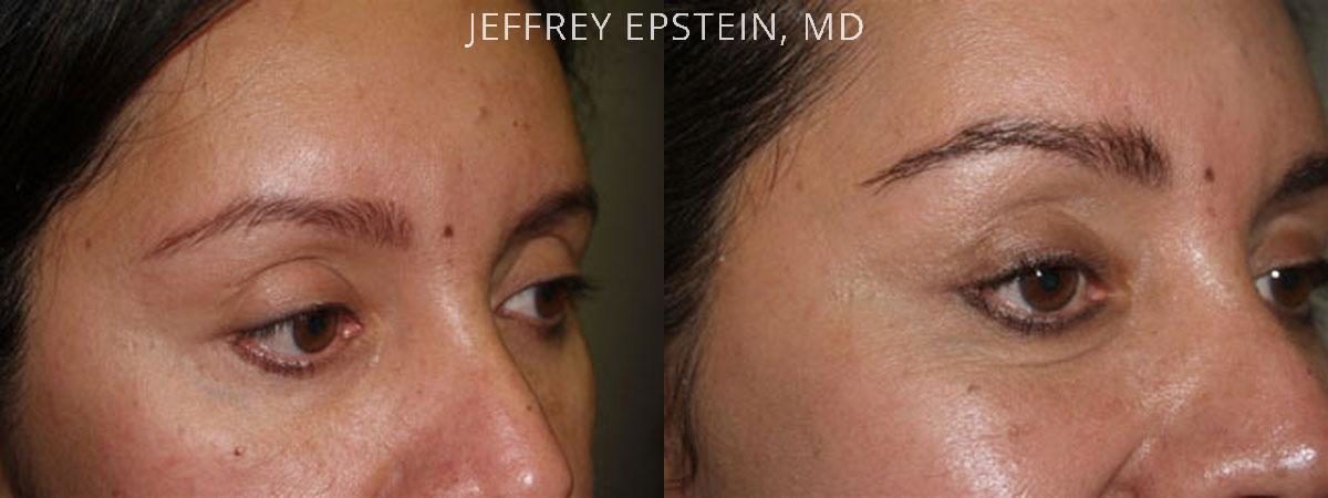 Eyebrow Before and after in Miami, FL, Paciente 36044