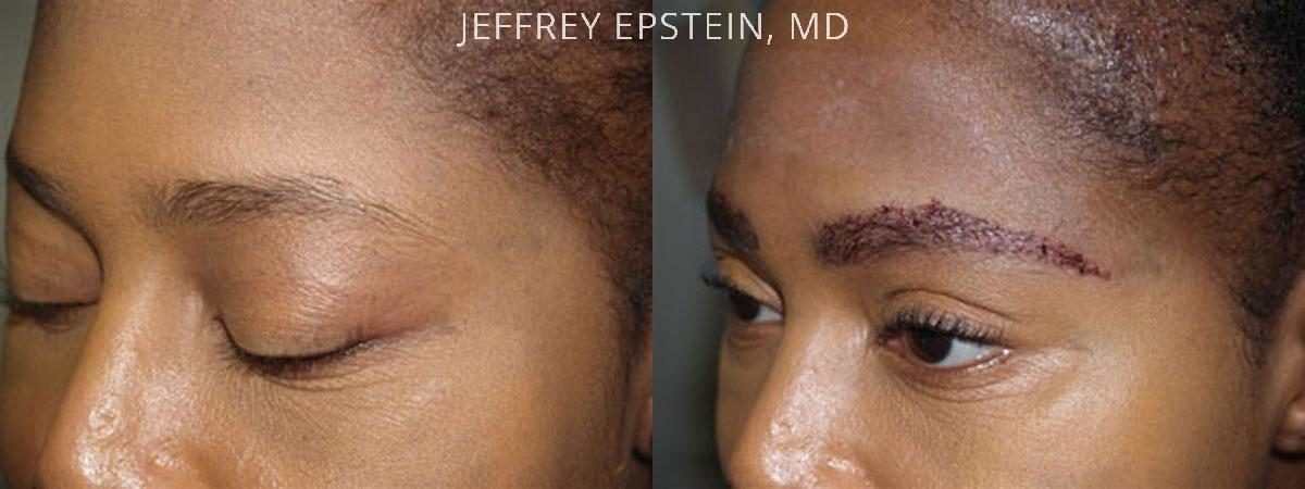 Eyebrow Hair Transplant Before and after in Miami, FL, Paciente 36058