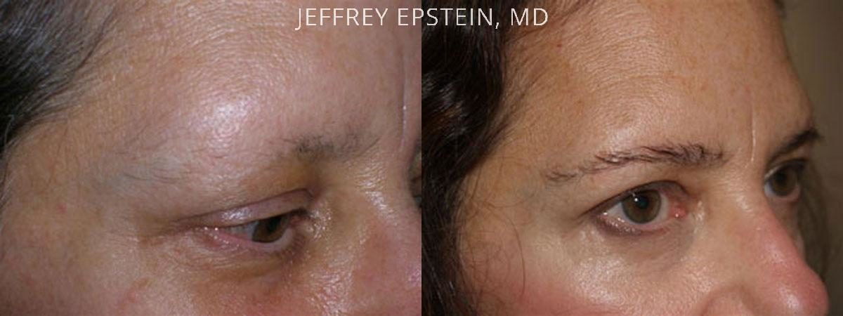 Eyebrow Hair Transplant Before and after in Miami, FL, Paciente 36061