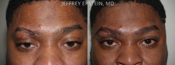 Eyebrow Hair Transplant Before and after in Miami, FL, Paciente 36107