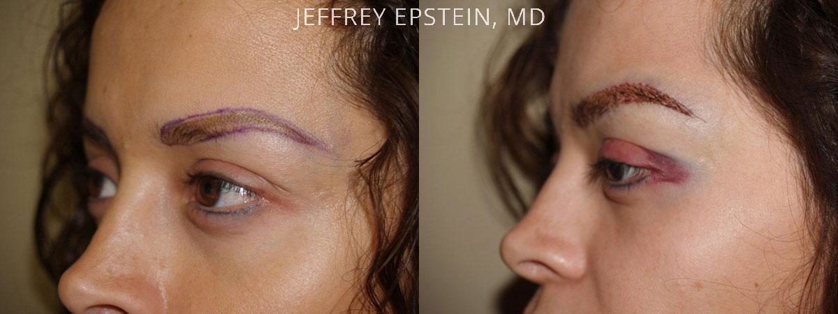 Eyebrow Before and after in Miami, FL, Paciente 36121