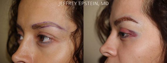 Eyebrow Hair Transplant Before and after in Miami, FL, Paciente 36121