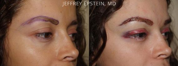 Eyebrow Hair Transplant Before and after in Miami, FL, Paciente 36121