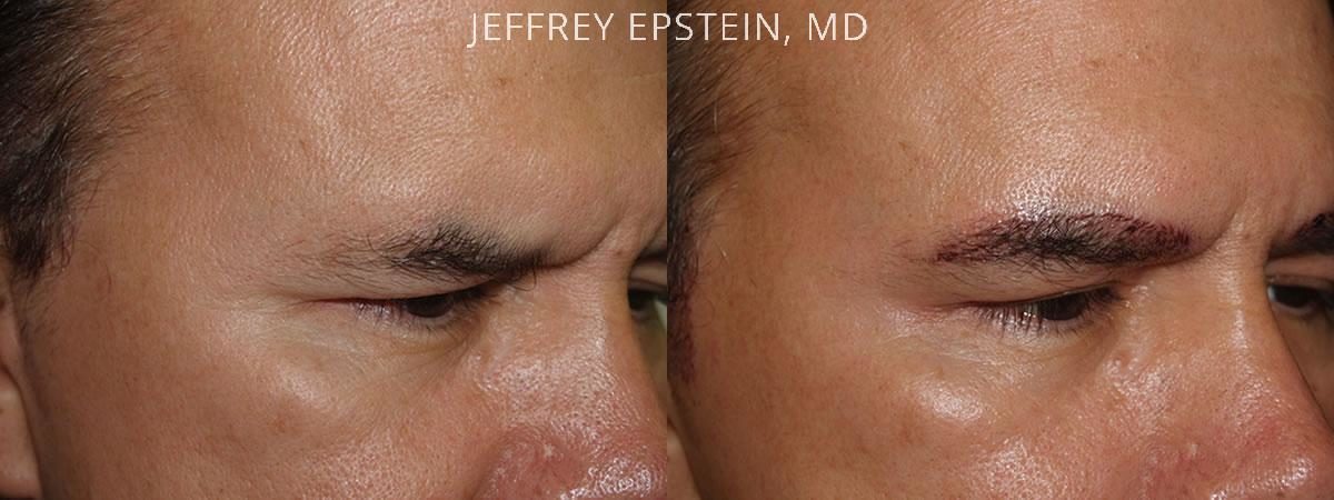Eyebrow Hair Transplant Before and after in Miami, FL, Paciente 36193