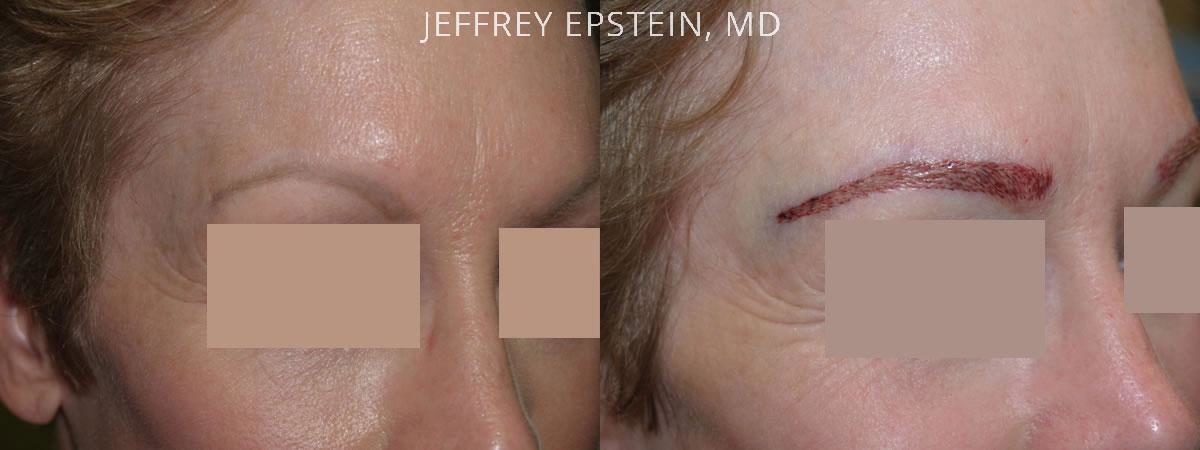 Eyebrow Before and after in Miami, FL, Paciente 36196