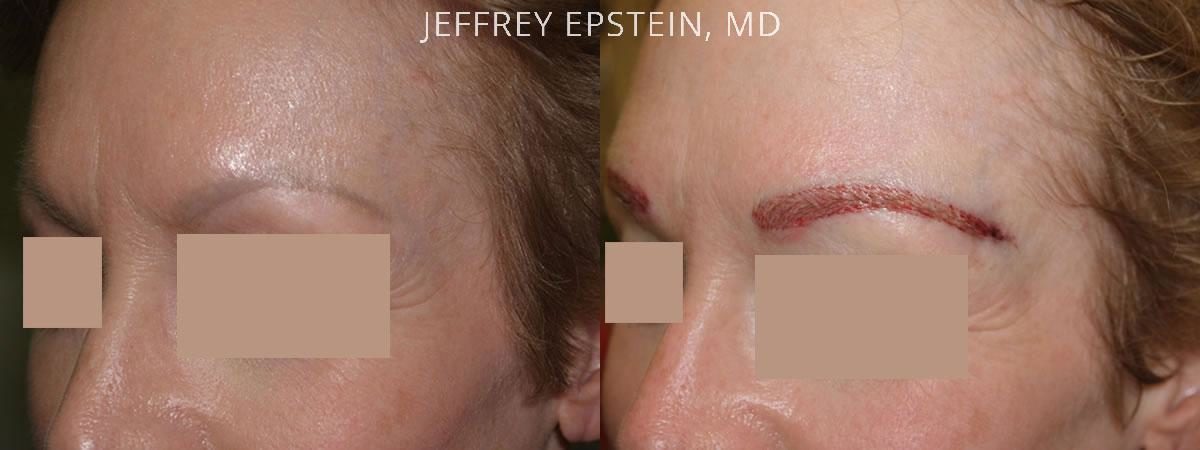 Eyebrow Hair Transplant Before and after in Miami, FL, Paciente 36196