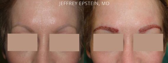 Eyebrow Hair Transplant Before and after in Miami, FL, Paciente 36196