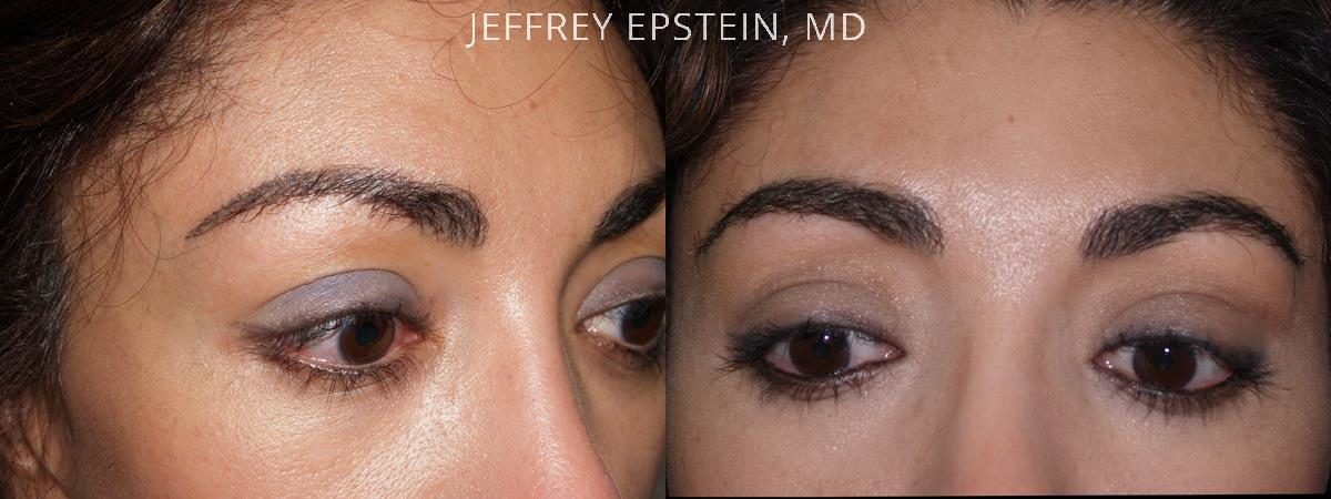Eyebrow Before and after in Miami, FL, Paciente 36221