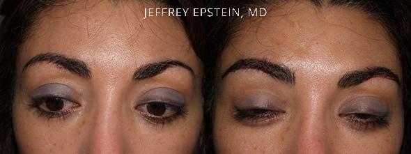 Eyebrow Hair Transplant Before and after in Miami, FL, Paciente 36221