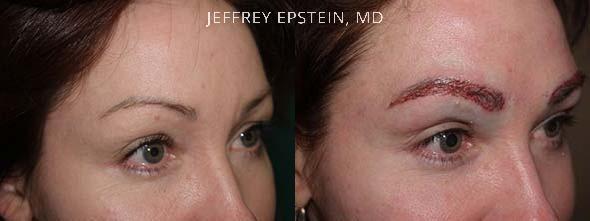 Eyebrow Before and after in Miami, FL, Paciente 36233
