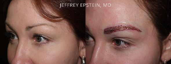 Eyebrow Hair Transplant Before and after in Miami, FL, Paciente 36233