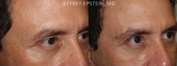Eyebrow Hair Transplant Before and after in Miami, FL, Paciente 36240