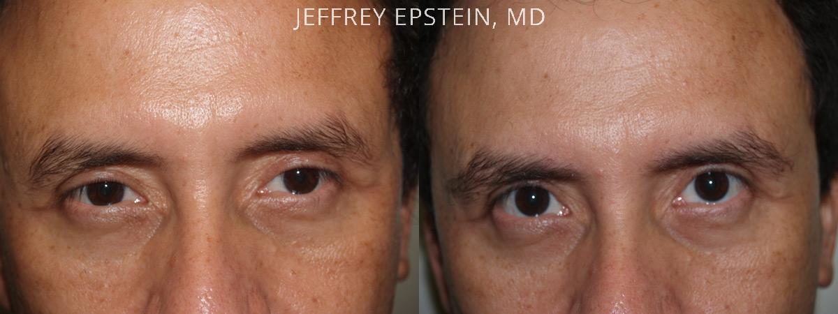 Eyebrow Before and after in Miami, FL, Paciente 36240
