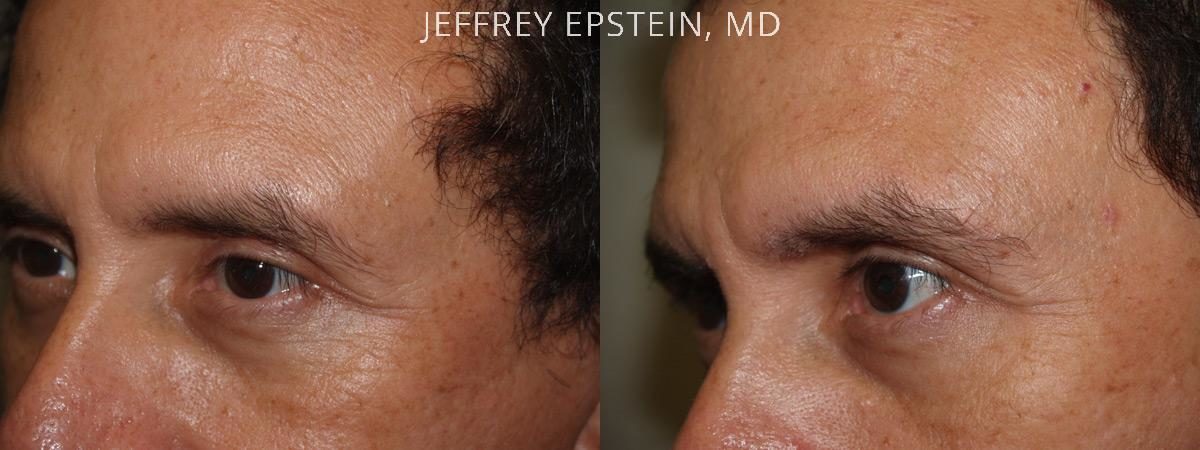 Eyebrow Hair Transplant Before and after in Miami, FL, Paciente 36240