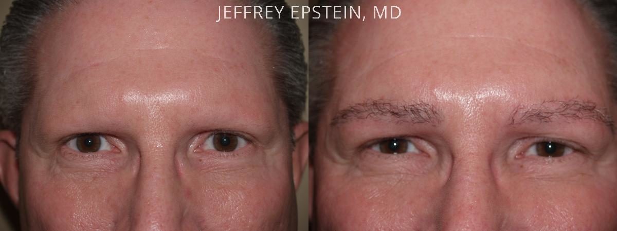 Eyebrow Hair Transplant Before and after in Miami, FL, Paciente 36247