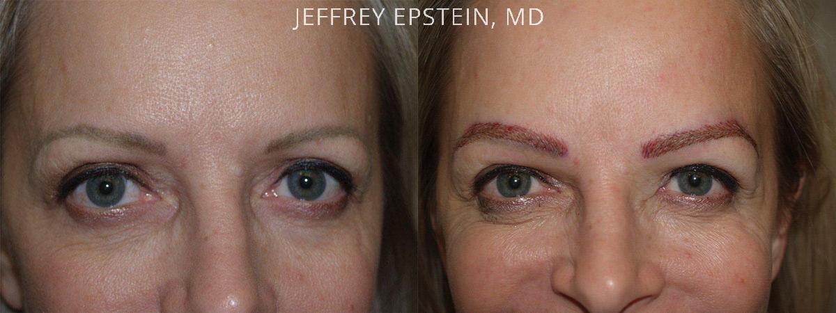 Eyebrow Hair Transplant Before and after in Miami, FL, Paciente 36257