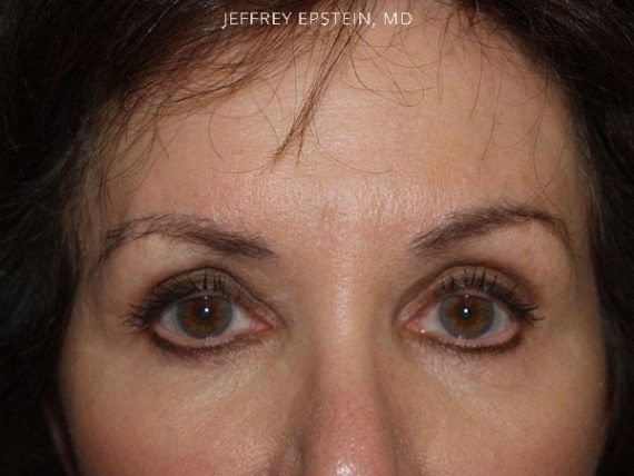 Eyebrow Hair Transplant Before and after in Miami, FL, Paciente 36269