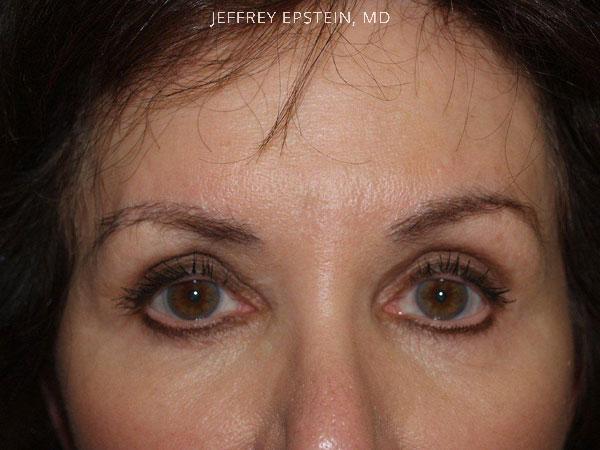 Eyebrow Before and after in Miami, FL, Paciente 36269