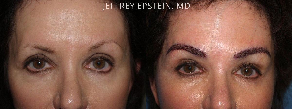 Eyebrow Before and after in Miami, FL, Paciente 36269