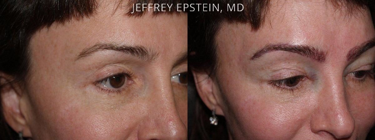 Eyebrow Before and after in Miami, FL, Paciente 36278