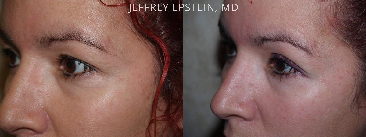 Eyebrow Before and after in Miami, FL, Paciente 36285