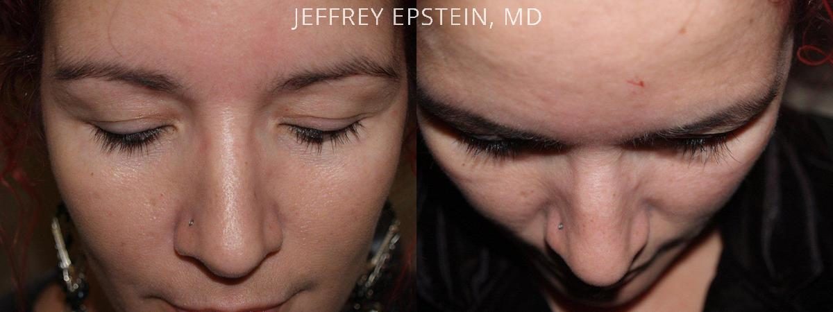 Eyebrow Before and after in Miami, FL, Paciente 36285