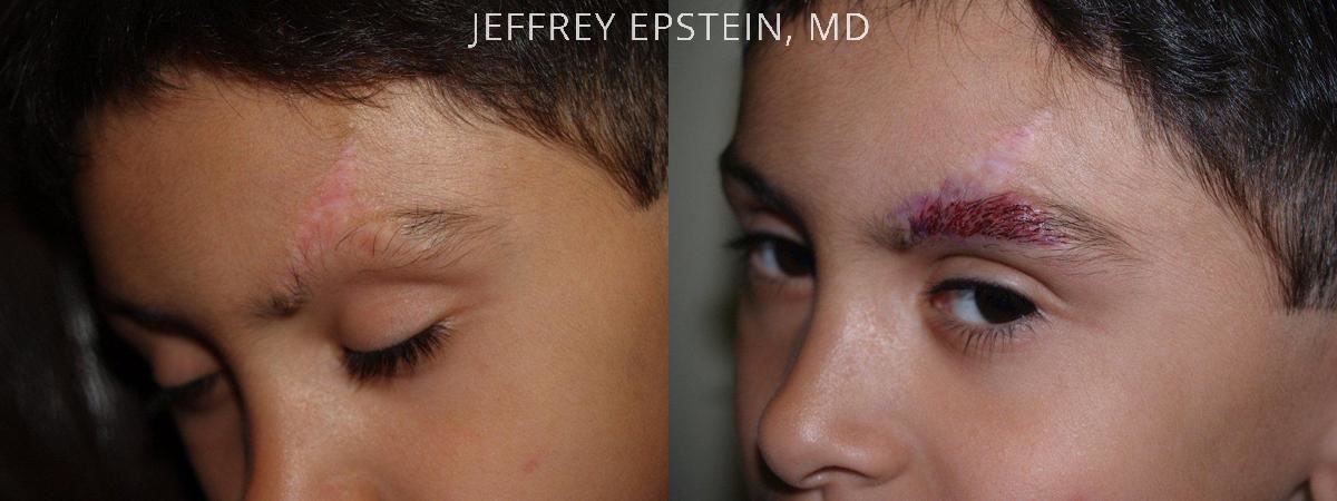 Eyebrow Hair Transplant Before and after in Miami, FL, Paciente 36304