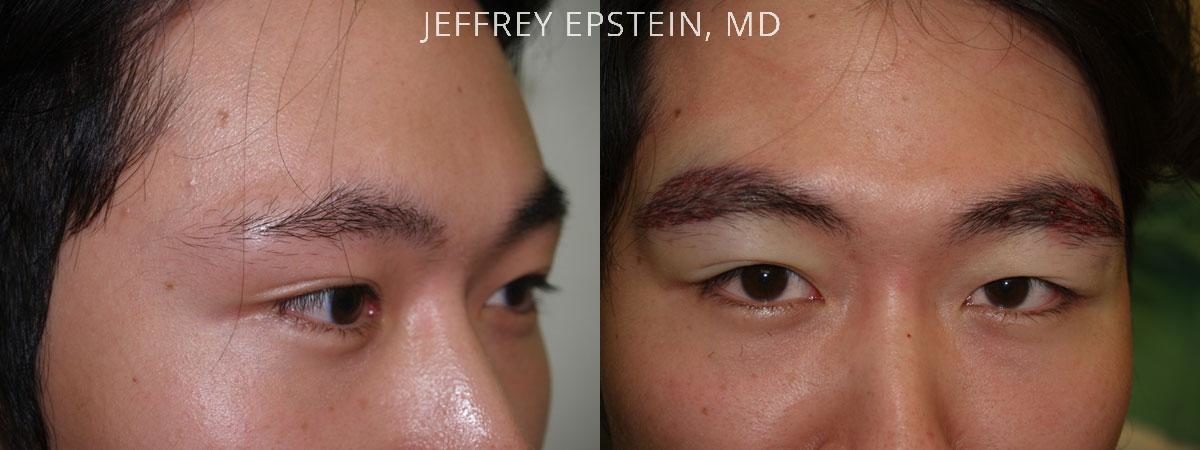 Eyebrow Hair Transplant Before and after in Miami, FL, Paciente 36340