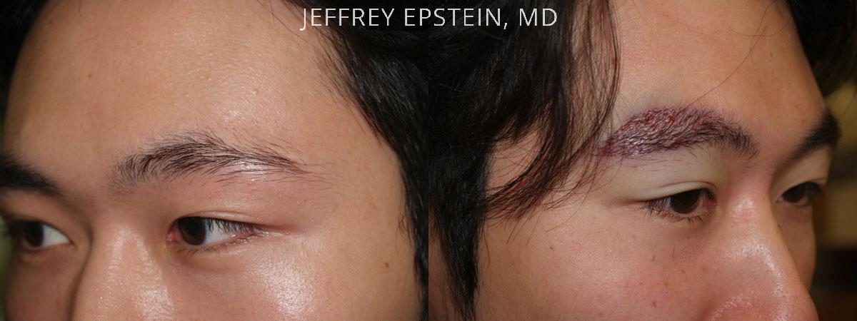 Eyebrow Hair Transplant Before and after in Miami, FL, Paciente 36340