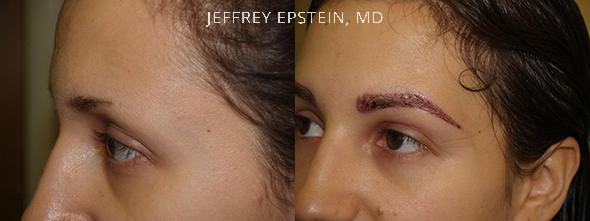 Eyebrow Hair Transplant Before and after in Miami, FL, Paciente 36359