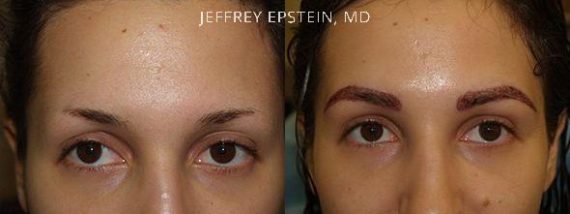Eyebrow Hair Transplant Before and after in Miami, FL, Paciente 36359