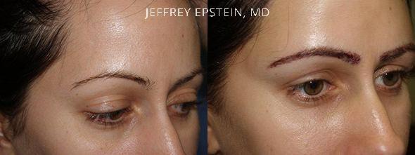 Eyebrow Hair Transplant Before and after in Miami, FL, Paciente 36366