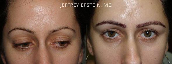 Eyebrow Hair Transplant Before and after in Miami, FL, Paciente 36366