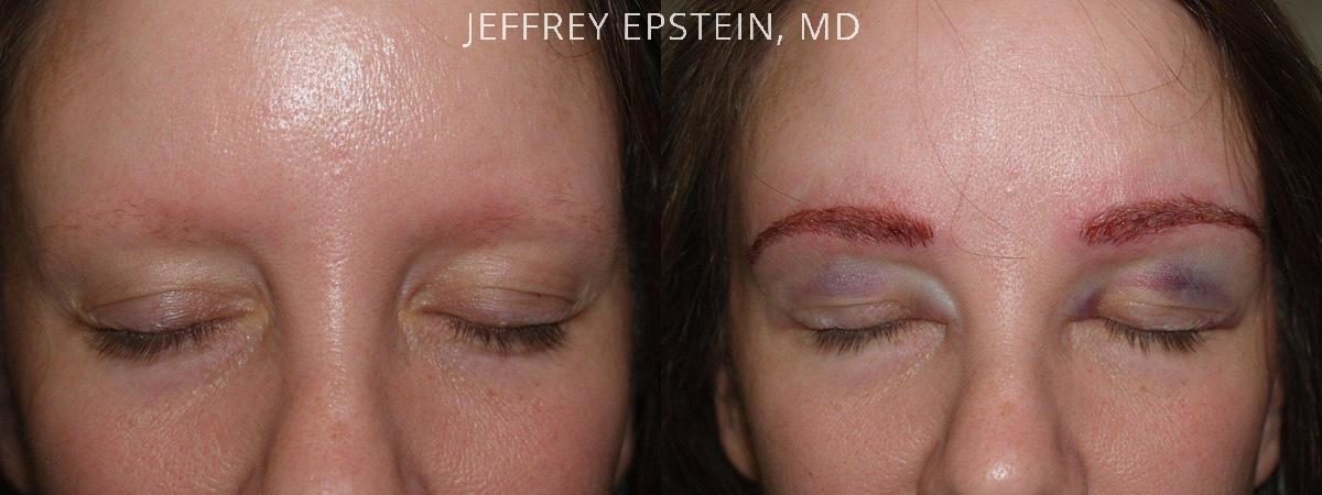 Eyebrow Hair Transplant Before and after in Miami, FL, Paciente 36373