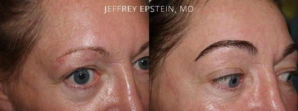 Eyebrow Hair Transplant Before and after in Miami, FL, Paciente 36380