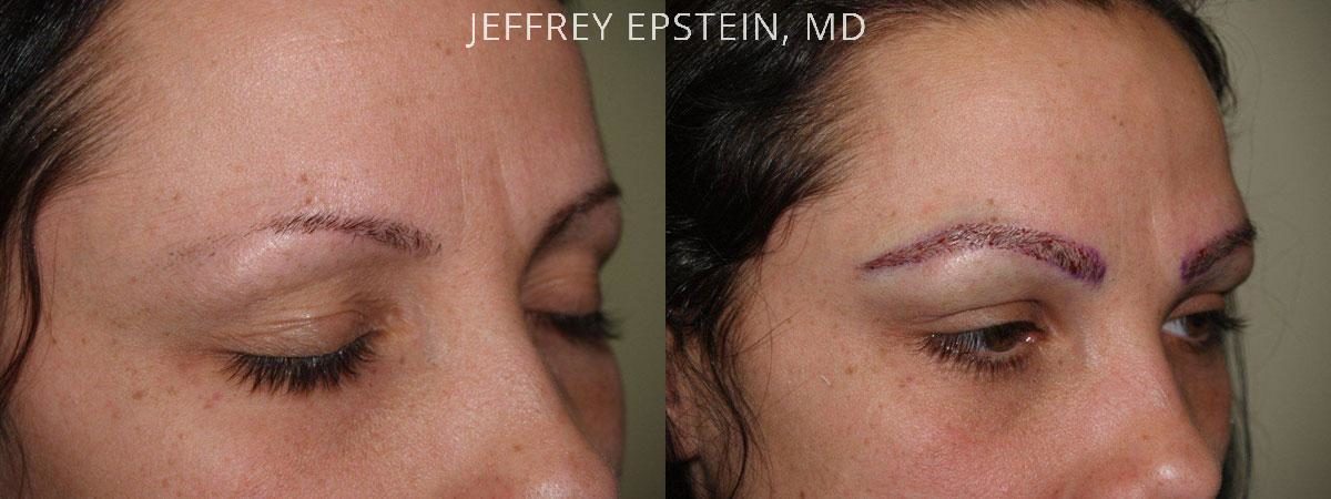 Eyebrow Hair Transplant Before and after in Miami, FL, Paciente 36390